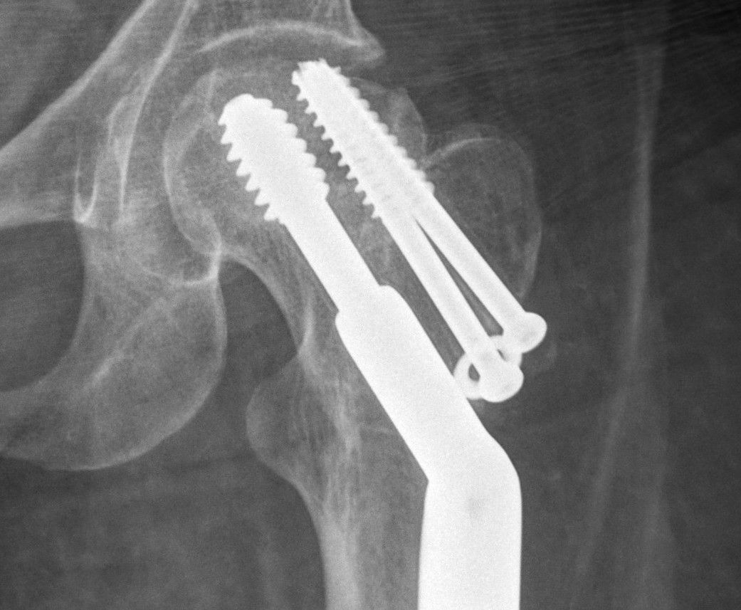 X-ray image of how my hip was fixed previously, one long piece running through the femur, and diagonally above that two screws going into the side of the neck of the femur. The tip of those screws is edging beyond the bone.