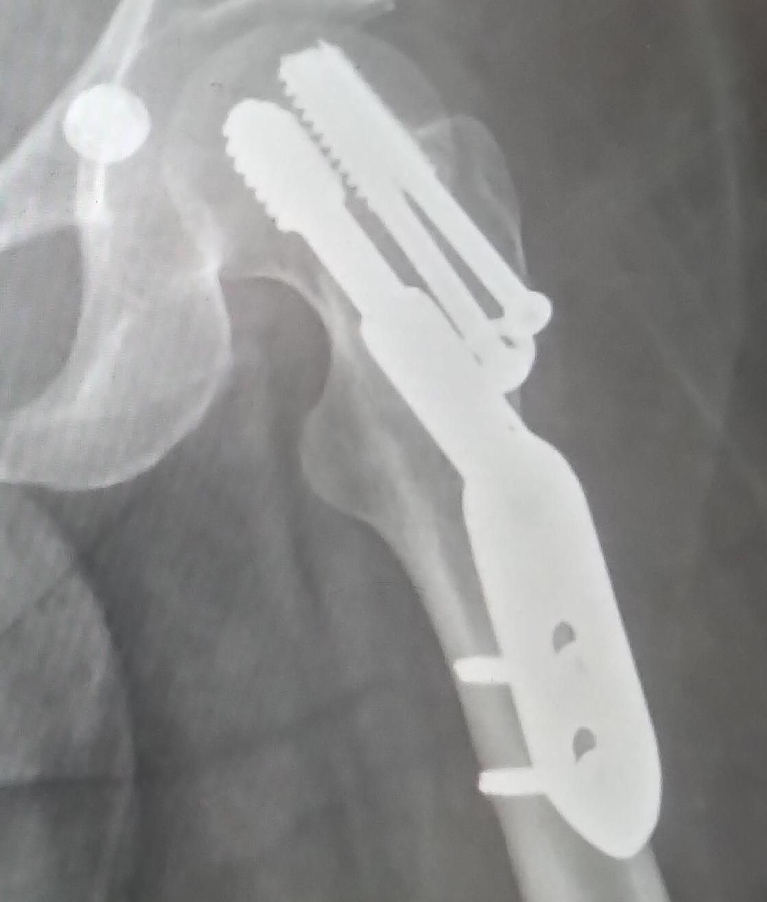 X-ray of the hip: metal is attached to the femur, two screws in a hinge alongside a longer piece that goes along the bone