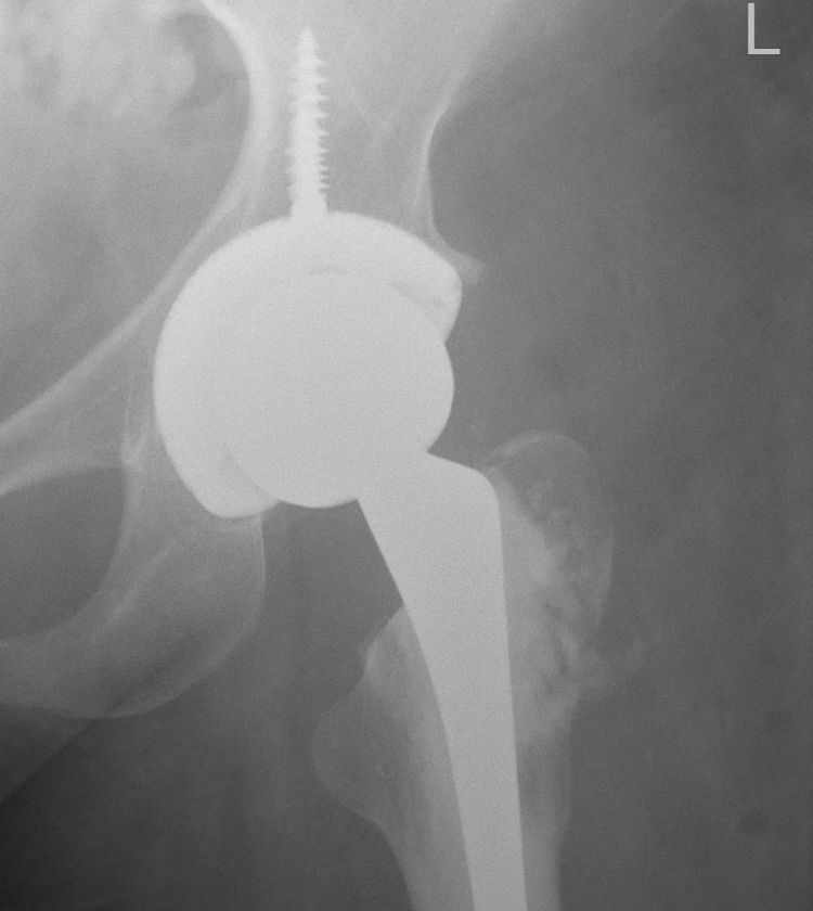X-ray image: a ball in the pelvis, a socket around it, a screw pointing upwards, and an extension downwards into the femur.